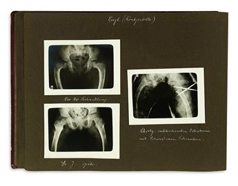 PEDIATRIC ORTHOPEDICS. Album of 84 silver print photographs of 21 patients before and after treatment. Germany, circa 1928-29